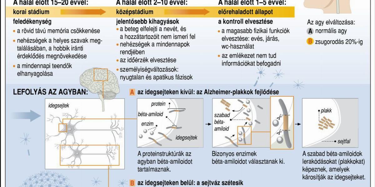 Az Alzheimer-kór a felejtés betegsége; az ábra a betegség lefolyását ismerteti. Forrás: MTI